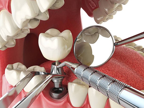 Best Emergency Treatment for Dental Infections or Abscesses in Chardon, OH